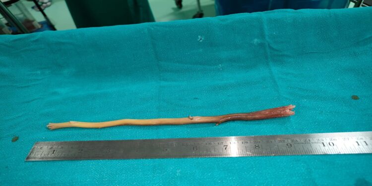 दातून करते वक्त खाने की नली में फंस गई लकड़ी, 7 दिन तक भूखे रहे 80 वर्षीय बुजुर्ग, ऑपरेशन के बाद ली राहत की सांस