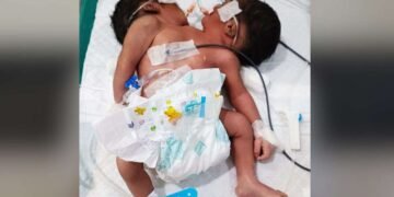 अस्पताल में हुआ दो सिर वाले बच्चे का जन्म, चमत्कार या मेडिकल डिसॉर्डर? डॉक्टरों की निगरानी में नवजात
